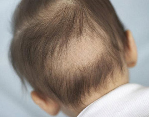 How to prevent baby bald spots forming 